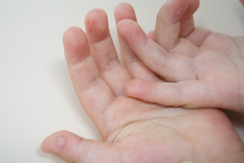 Japanese,Child,With,Hand-foot-and-mouth,Disease